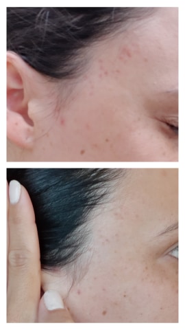 Miel de Manuka : Ma routine anti cicatrices d'acné - Pachanana